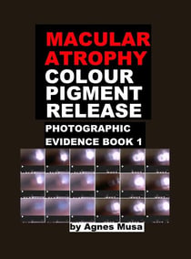 Macular Atrophy Colour Pigment Release, Photographic Evidence Book 1 - Macular Degeneration Atrophy, Photographic Evidence Series of   Books, #12