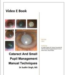 Cataract And Small Pupil Management Manual Techniques - 2022, #1