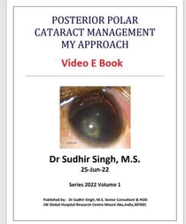 Posterior Polar Cataract Management: My Approach - 2022, #1