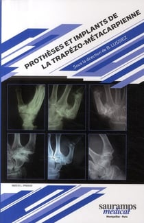 Prothèses et implants de la trapézo métacarpienne