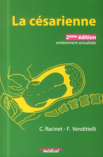 La césarienne