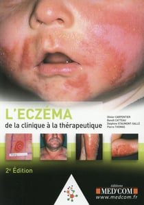 L eczema. de la clinique au traitement. 2  ed