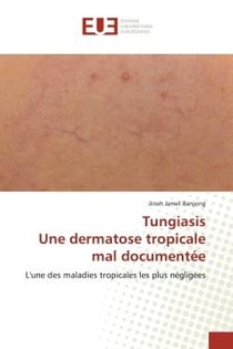 TungiasisUne dermatose tropicale mal documentée : L'une des maladies tropicales les plus négligées