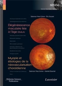 Dégénérescence maculaire liée à l'âge (DMLA) - myopie et étiologies de la néovascularisation choroïdienne