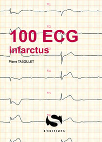 100 ECG infarctus