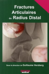 Fractures articulaires du radius distal