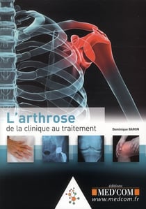 L'arthrose : de la clinique au traitement