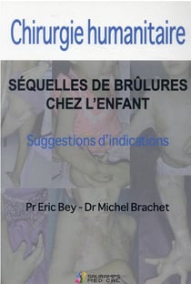 Chirurgie humanitaire : séquelles de brûlures chez l'enfant - suggestions d'indications