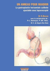 Un anneau pour maigrir - la gastroplastie horizontale calibrée ajustable sous laparoscopie