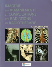 Imagerie des ramaniements et complications des radiations en radiothérapie