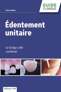 Édentement unitaire : Le bridge collé cantilever
