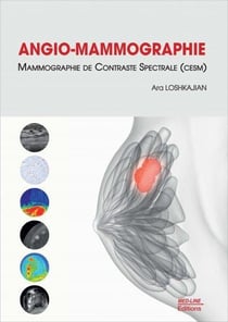 Angio-mammographie : Mammographie de contraste spectrale (CESM)