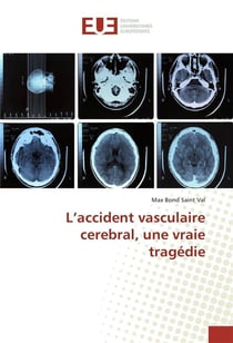 L'accident vasculaire cerebral, une vraie tragedie