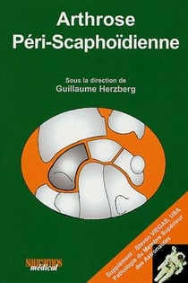 Arthrose péri-scaphoïdienne