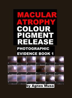 Macular Atrophy Colour Pigment Release, Photographic Evidence Book 1 - Macular Degeneration Atrophy, Photographic Evidence Series of   Books, #12