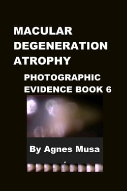 Macular Degeneration Atrophy, Photographic Evidence Book 6 - Macular Degeneration Atrophy, Photographic Evidence Series of   Books, #8