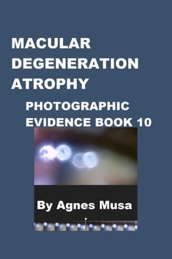 Macular Degeneration Atrophy, Photographic Evidence Book 10 - Macular Degeneration Atrophy, Photographic Evidence Series of   Books, #2