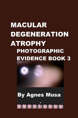 Macular Degeneration Atrophy, Photographic Evidence Book 3 - Macular Degeneration Atrophy, Photographic Evidence Series of   Books, #5