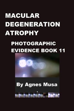 Macular Degeneration Atrophy, Photographic Evidence Book 11 - Macular Degeneration Atrophy, Photographic Evidence Series of   Books, #3