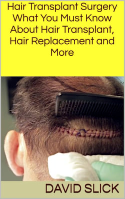 Hair Transplant Surgery - What You Must Know About Hair Transplant, Hair Replacement and More