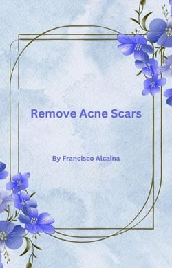 Remove Acne Scars