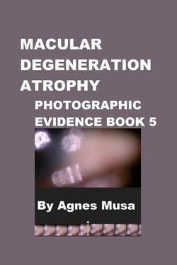Macular Degeneration Atrophy, Photographic Evidence Book 5 - Macular Degeneration Atrophy, Photographic Evidence Series of   Books, #7