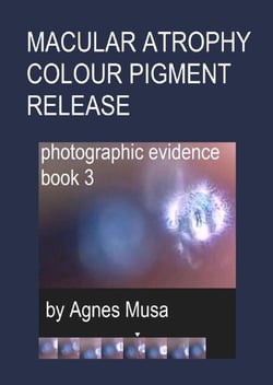 Macular Atrophy Colour Pigment Release, Photographic Evidence Book 3 - Macular Degeneration Atrophy, Photographic Evidence Series of   Books, #14