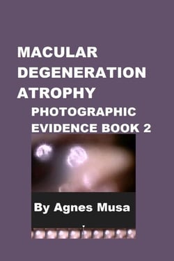 Macular Degeneration Atrophy, Photographic Evidence Book 2 - Macular Degeneration Atrophy, Photographic Evidence Series of   Books, #4