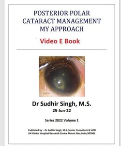 Posterior Polar Cataract Management: My Approach - 2022, #1
