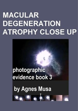 Macular Degeneration Atrophy Close Up, Photographic Evidence Book 3 - Macular Degeneration Atrophy, Photographic Evidence Series of   Books, #19