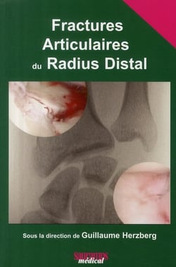 Fractures articulaires du radius distal