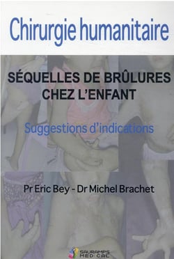 Chirurgie humanitaire : séquelles de brûlures chez l'enfant - suggestions d'indications