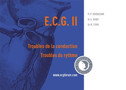 Ecg ii : troubles de la conduction, troubles du rythme