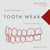 Tooth Wear - Interceptive treatment approach with minimally invasive protocols