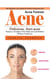 Acne: The Ultimate Cure Guide for How to Overcome Your Acne Forever (Delicious, Anti-acne Recipes to Transform Your Body and Look Radiant without Antibiotics)