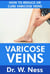Varicose Veins: How To Reduce Or Cure Varicose Veins