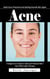 Acne: Adult Acne Treatment and Getting Smooth Skin Again (A Beginner’s Guide to Safe and Natural Skin Care With Light Therapy)