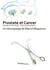 Prostate et cancer, blocages et incontinences - quatre années de galère