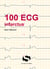 100 ECG infarctus
